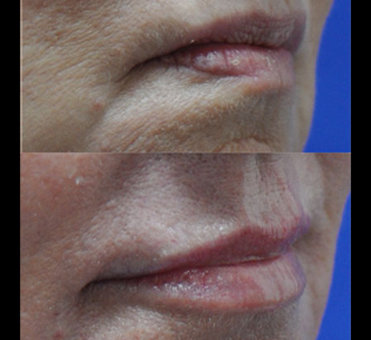 The side-by-side comparison of the before and after images underscores the remarkable effects of lip treatment on the woman's lip fullness and shape.