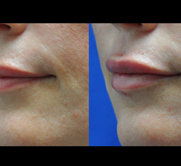 The before picture highlights concerns related to thin lips, while the after photo portrays a fuller and more defined lip look post-treatment.