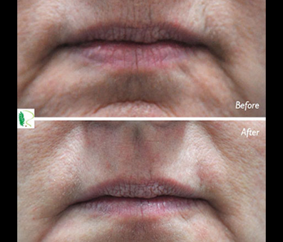 Before and after lip treatment
