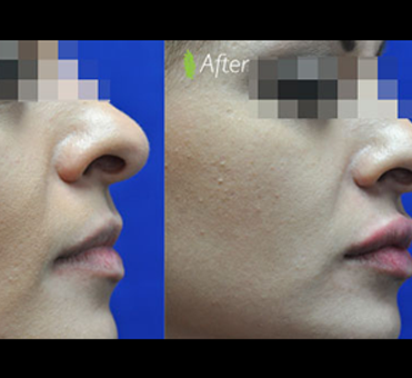 The contrast between the before and after photos emphasizes the significant changes in the woman's lip appearance after undergoing lip treatment.