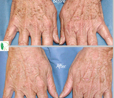 woman Hands looking fresh after treatment