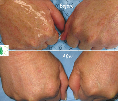 woman's hands before and after rejuvimed treatment