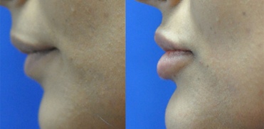 In the before photo, the woman's lips appear thin and lack volume, but in the after image, the lip treatment has significantly enhanced her lip appearance.