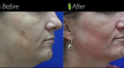 The woman's face in the before image shows excess fat beneath the chin, while the after picture reveals a significant transformation following double chin treatment.