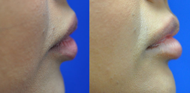 The woman's lips in the before image look flat and less defined, while the after picture showcases a noticeable transformation following lip treatment.