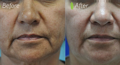 The side-by-side comparison of the before and after images underscores the significant effects of double chin treatment on the woman's facial structure.