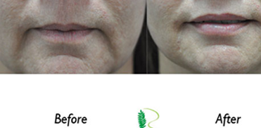 Lip treatment has provided a distinct improvement in the woman's lip fullness and definition, as seen in the before and after images.