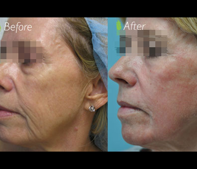In the before photo, the woman's face exhibits signs of aging, but in the after image, the treatment has significantly rejuvenated her appearance.