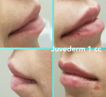 Juvederm 1cc lip enhancement treatment