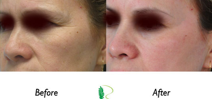 In the initial photo, the woman's face displayed signs of eye fatigue, but in the second image, the results of the eye treatment are strikingly clear