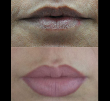 Lip treatment has significantly improved the woman's lip appearance, achieving the desired fullness and definition, as seen in the side-by-side comparison of the before and after photos.