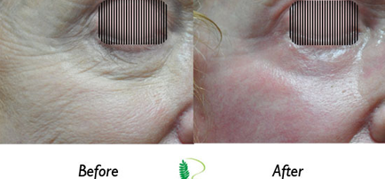 The progression from the before image with dark circles and puffiness to the after image with a more awake look highlights the effectiveness of the eye treatment.