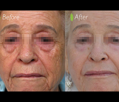 Rejuvimed Treatment has provided a marked enhancement in the woman's facial appearance, as seen in the before and after images.