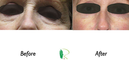 Before the eye treatment, the man's eyes looked tired and aged, but the after image showcases a significant improvement