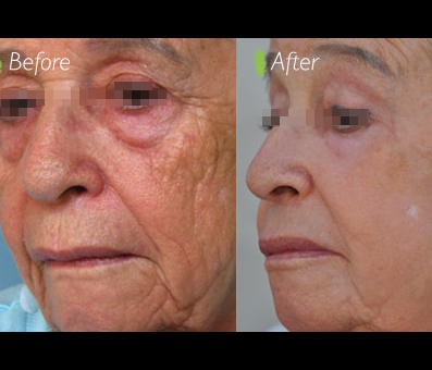 The contrast between the before and after photos emphasizes the significant changes in the woman's face, particularly in terms of a more youthful appearance, after undergoing treatment.