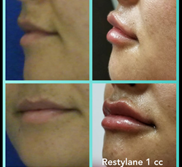 Restylane 1cc lip enhancement treatment