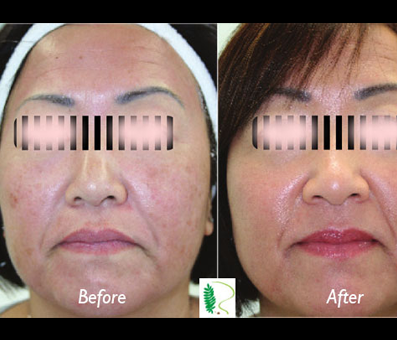 The side-by-side comparison of the before and after images underscores the remarkable effects of treatment on the woman's facial appearance.