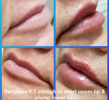 Restylane 0.5 enough to evert upper lip and plump lower lip