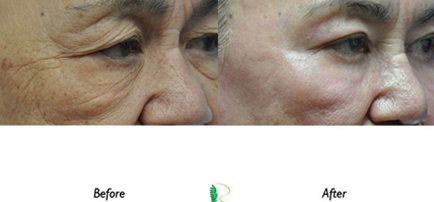 The before and after images offer a compelling visual representation of the transformative impact of eye treatment on the woman's face, particularly around the eyes