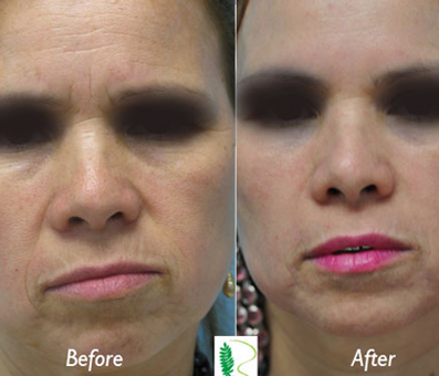 The woman's facial appearance in the before photo reflects the presence of signs of aging, but in the after image, the treatment has achieved a more youthful and revitalized look.