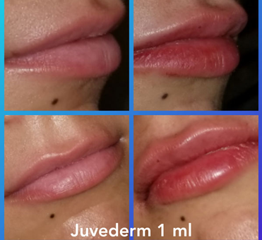 Juvederm 1ml lip enhancement treatment