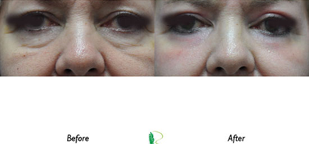 The transformation from the initial image with eye concerns to the subsequent image with a more refreshed look emphasizes the effectiveness of the eye treatment.