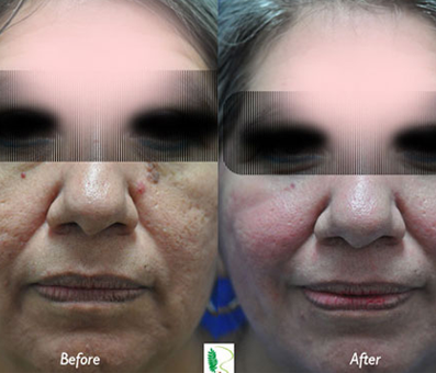 The before picture highlights concerns related to aging, including wrinkles, while the after photo portrays a more vibrant and refreshed look post-treatment.