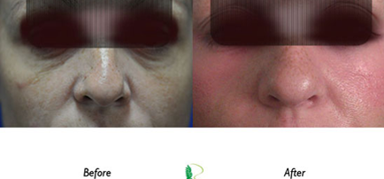 In the before photo, the woman's face shows signs of tiredness and puffiness around the eyes, but in the after image, the eye treatment has rejuvenated his appearance.