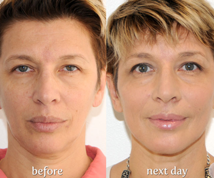 Y-Lift treatment has visibly transformed woman's facial contours, as evident in the side-by-side comparison of the before and after photos.
