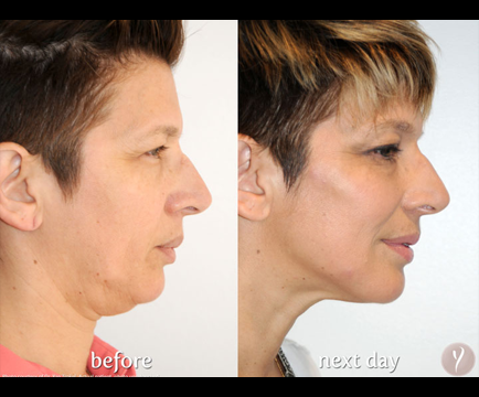 The before and after images offer a compelling visual representation of the transformative impact of Y-Lift treatment on the man's face.