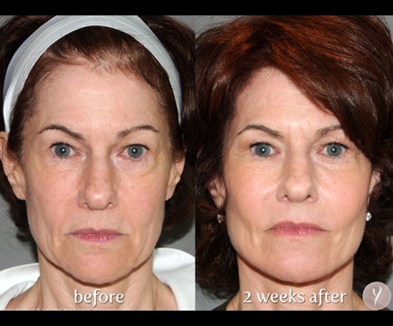 The change in the woman's facial features from before to after Y-Lift treatment is truly remarkable, showcasing a newfound youthful radiance.