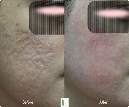 Acne treatment has visibly improved the man's skin, as seen in the side-by-side comparison of the before and after images.