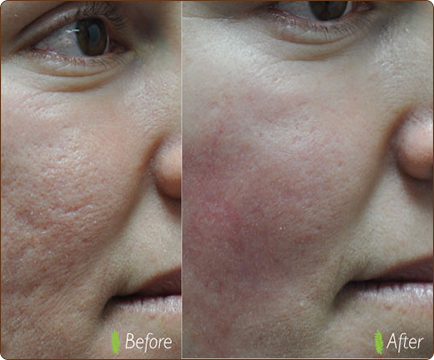 The before-and-after pictures depict the positive impact of acne treatment on woman's face, with a noticeable reduction in blemishes and acne scars.