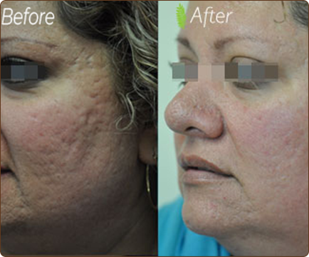 Woman's face before acne treatment reveals the struggle with skin imperfections, which are remarkably diminished in the after image.