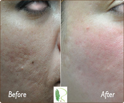 In the initial photo, woman's face shows signs of acne scarring, but in the second image, the results of acne treatment are strikingly clear.