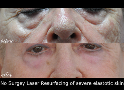 Eye treatment has provided a distinct improvement in the woman's facial appearance, as seen in the before and after images