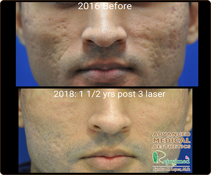 The man's face exhibits visible acne scars in the before photo, while the after photo showcases a noticeable improvement in his skin texture.