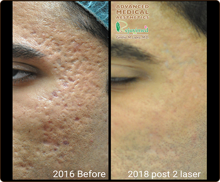 Before undergoing acne treatment, the man's face displayed blemishes and scars, which are significantly reduced in the after image.