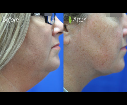 In the before photo, the woman's face exhibits a visible double chin, but in the after image, the double chin treatment has notably improved her facial profile.