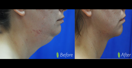 The progression from the before image with a double chin to the after image with a more sculpted and refined chin profile highlights the effectiveness of the treatment.