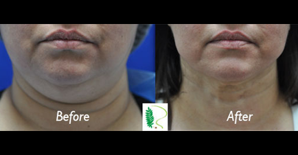 Before the double chin treatment, the woman's chin lacked definition, but the after image showcases a significant improvement in the chin's appearance.