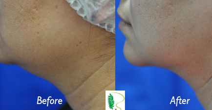 The difference in the woman's facial profile before and after double chin treatment is evident, with a more contoured and refined chin in the after image.