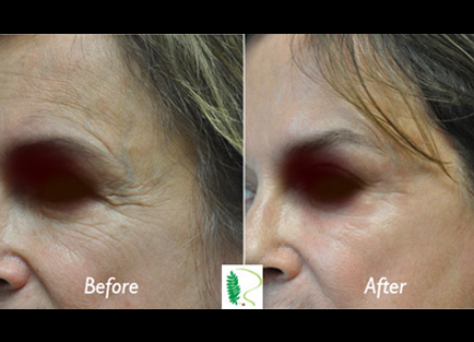 The contrast between the before and after photos highlights the significant changes in the woman's face, particularly in the eye area, after undergoing eye treatment
