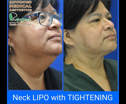 Double chin treatment has visibly transformed the woman's chin area, as evident in the side-by-side comparison of the before and after photos.