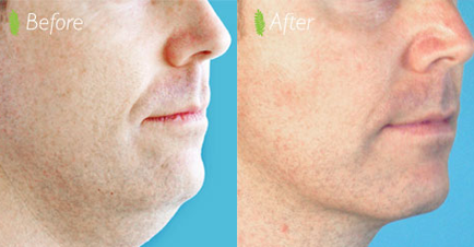 The change in the man's facial profile from before to after double chin treatment is truly remarkable, showcasing a more streamlined and defined look.