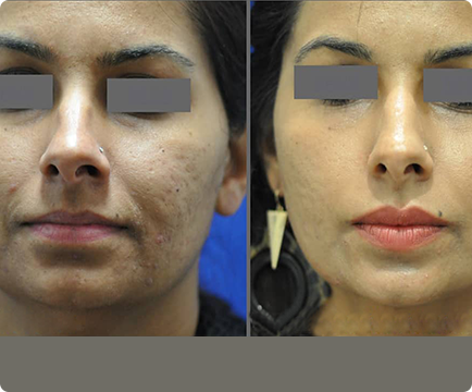 Before acne treatment, woman's skin was marked by scars, but the after image showcases a marked improvement in his skin's appearance.