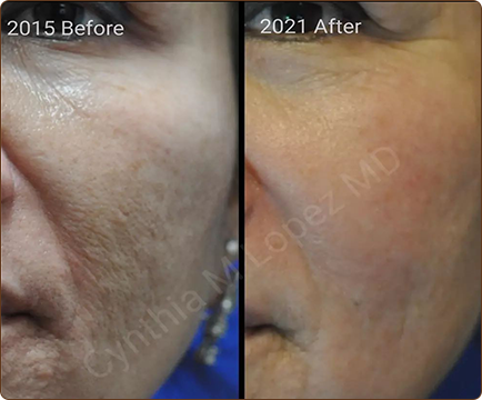 The before and after pictures offer a powerful visual representation of the positive impact of acne treatment on the woman's skin.