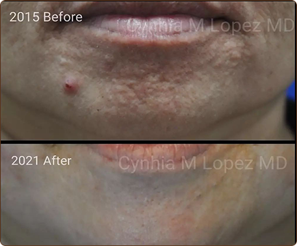 The before-and-after images provide a compelling visual narrative of the woman's journey to overcome acne and improve his skin.