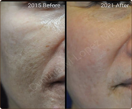 Acne treatment has visibly transformed woman's skin, as evident in the side-by-side comparison of the two images.
