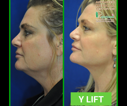 The before picture highlights age-related concerns on woman's face, while the after photo portrays a more youthful and refreshed look post-Y-Lift treatment.